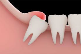wisdom tooth removal in Agra 