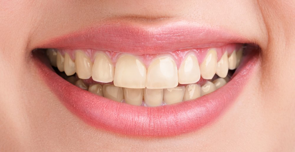 Teeth Whitening Cost in Agra 